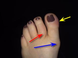 gout or ingrown nail?