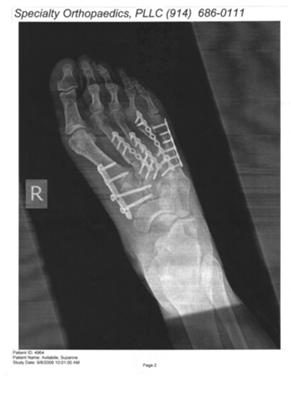 broken-metatarsals-21146372.jpg