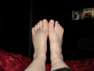 badly bruised foot secondary to trauma