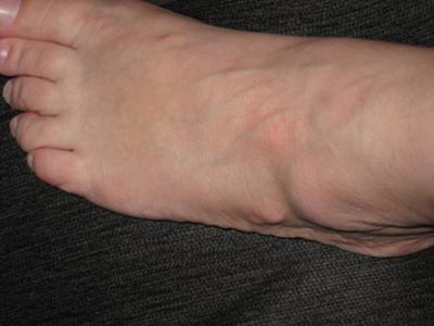 side of foot