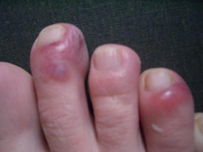 How is pain from red swollen toes treated?