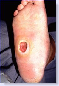 Foot Ulcer; Plantar Ulcer