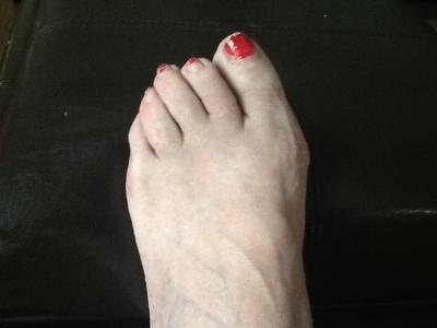 failed bunion and hammertoe surgery