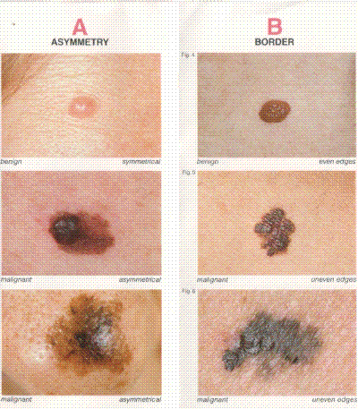 cancerous moles on foot. The top mole in each