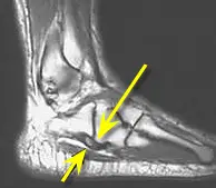 Accessory Navicular Syndrome