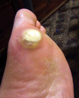 infected callus on foot
