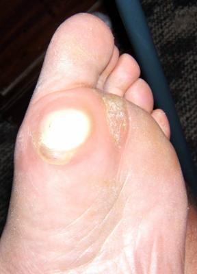 callus on bottom of foot