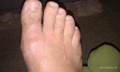 4 weeks post neuroma surgery