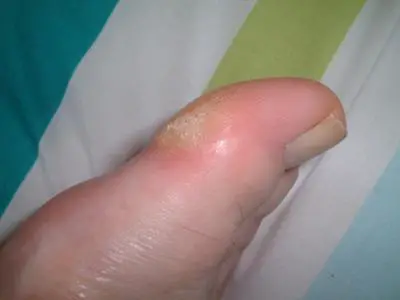 thickened skin on big toe