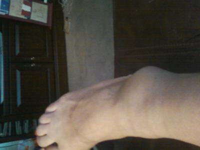 more swelling when I walk on it