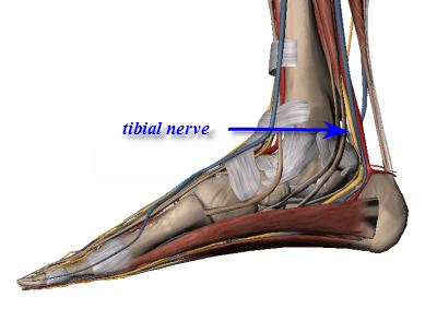 tibial nerve neuritis
