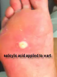 salicylic acid wart #10