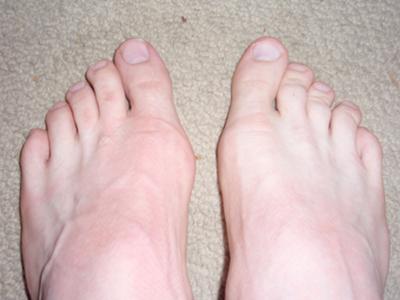 Bunions