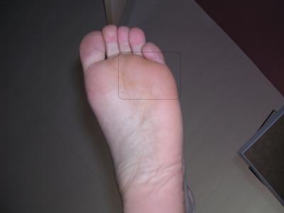 bruised foot