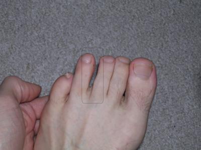 Morton's neuroma