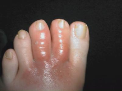Little itchy foot bumps - I cannot get a diagnosis ...