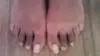 Both feet are different from hammertoe surgery
