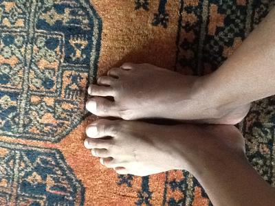 top of foot swelling