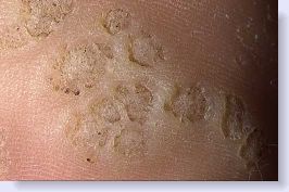 PLANTAR WART REMOVAL - YouTube