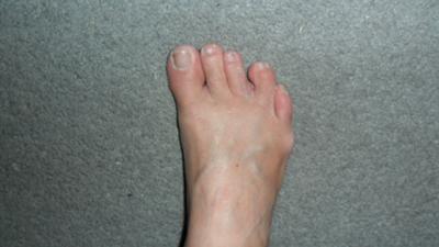  middle toe leans to the left