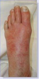 foot infection