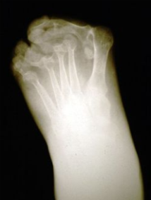 arthritic_foot_xray