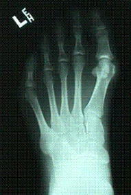 normal_foot_xray