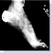crps damage xray