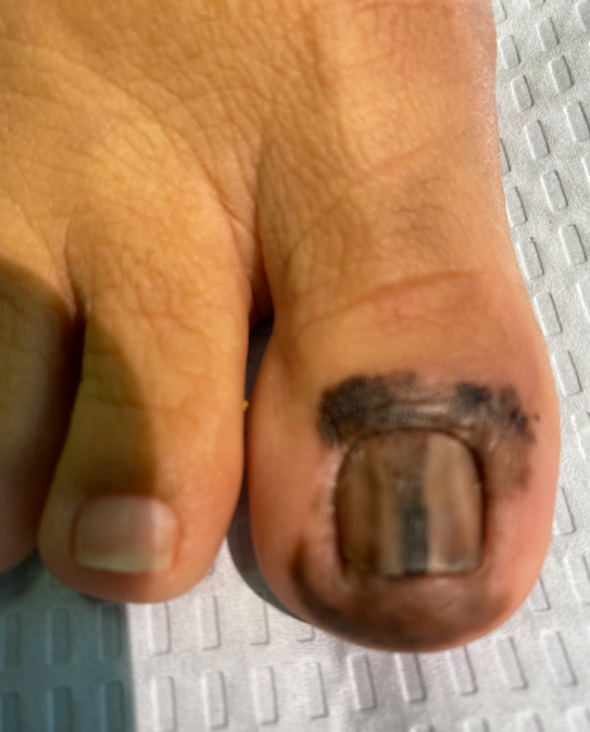 Acral lentiginous melanoma