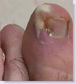 infected ingrown toe nail