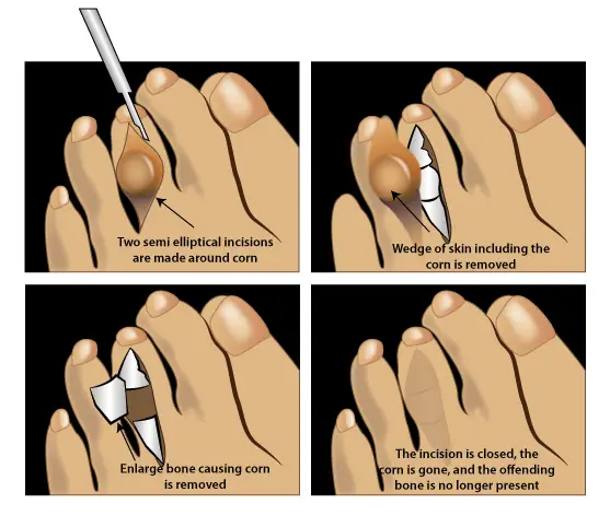 hammertoe arthroplasty