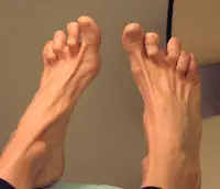 hammertoes