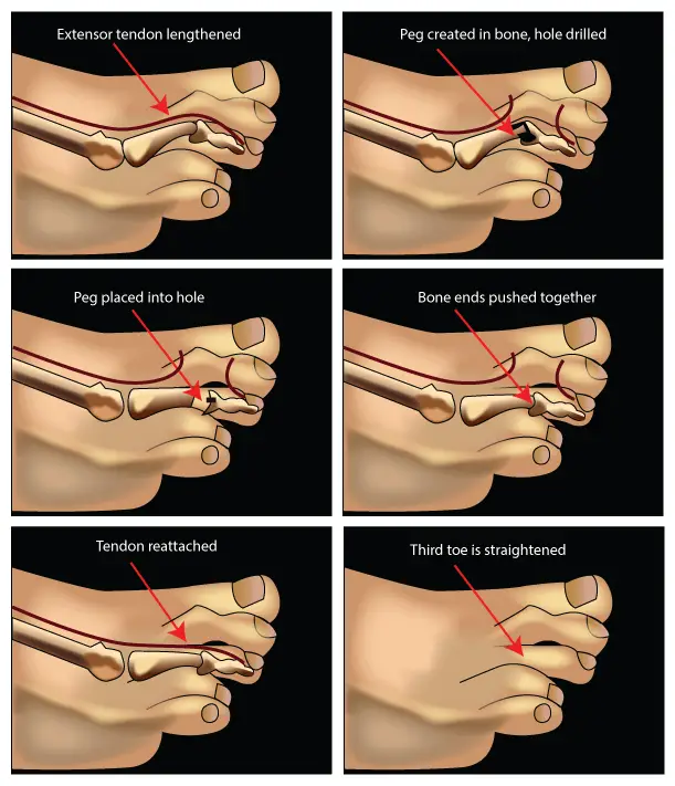 peg and hole procedure