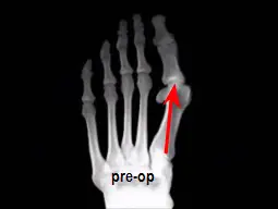 hallux limitus with narrowing of joint space