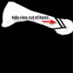 V osteotomy in metatarsal