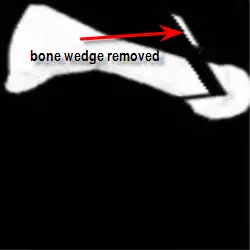 V osteotomy with wedge of bone removed