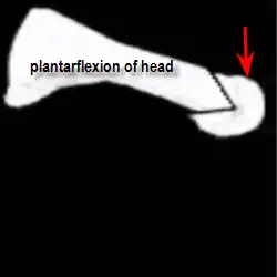 metatarsal head repositioned