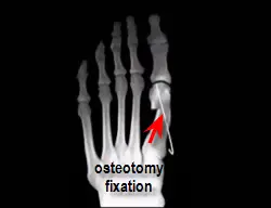 fixation of osteotomy