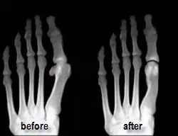 before and after Austin bunionectomy