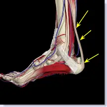 three areas of pain in Achilles tendonitis 