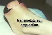 diabetic foot amputation