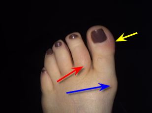 ingrown nail or gout?