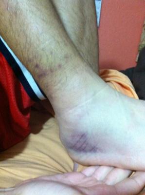 Freshly injured inversion sprain