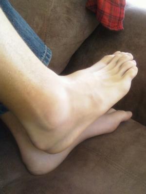 four weeks after lateral ankle sprain
