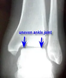 abnormal ankle mortise xray