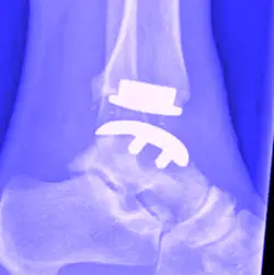 ankle implant