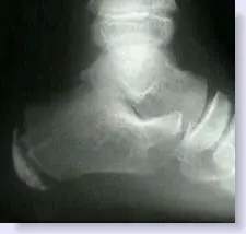 calcaneal apophysitis xray