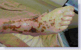 arterialsclerosis of foot