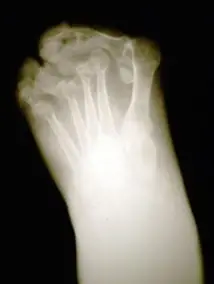 arthritis_foot_xray