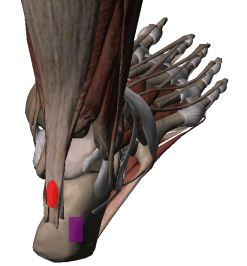 Achilles tendonitis or Haglund's deformity?